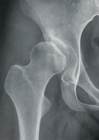 200 A B C Fig. 4. A 22-year-old female with chronic right hip pain. (A) The anteroposterior radiograph shows mild osteoarthritis (Tönnis grade 1).