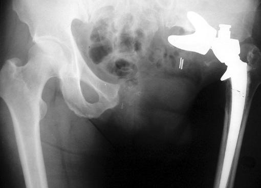 (A) Plain radiograph and MRI shows calcified mass extending from the superior ramus to the inner