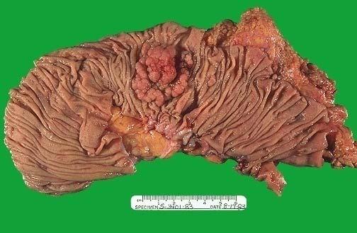 (Transverse colon, 10%): 장간막림프절