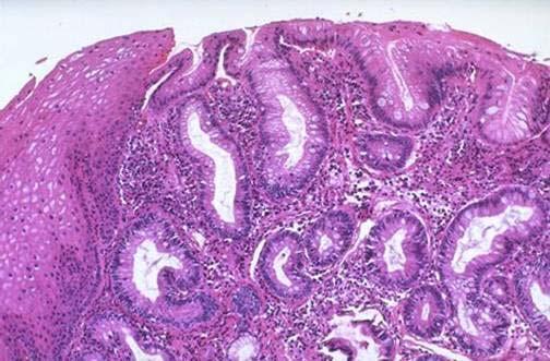 Barrett s Esophagus: - 편평상피의원주와배상세포 (columnar and