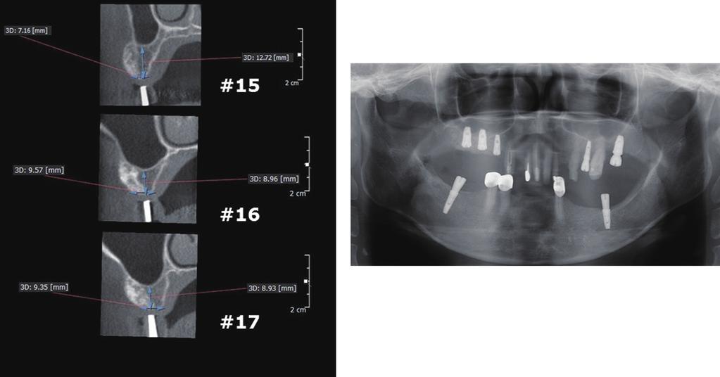 () Width of alveolar bone insufficient for #15, 16 and 17 implantation before ridge augmentation.