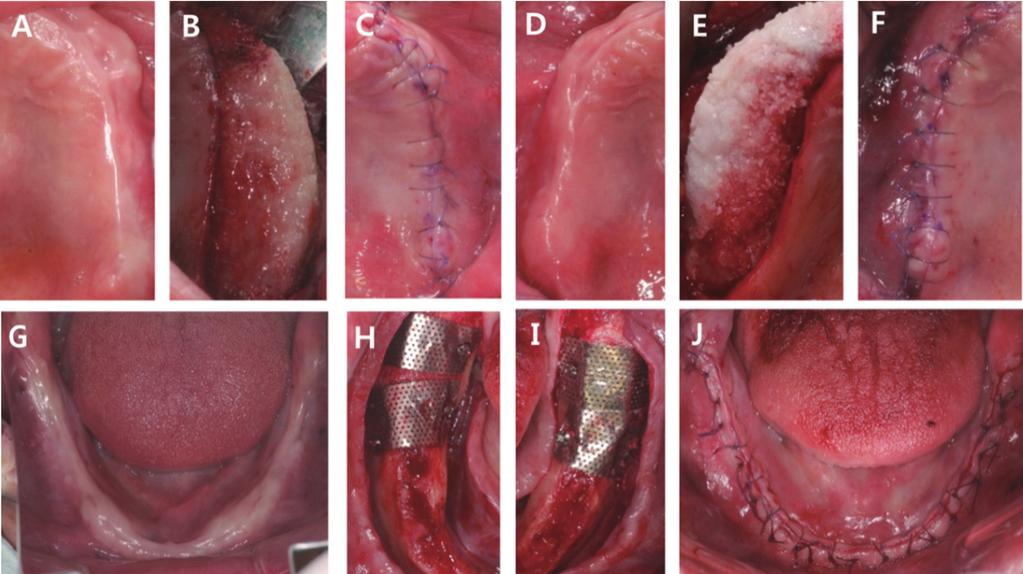 maxillary left area, (D) Pre-operative view of maxillary right area, (E) After alveolar bone augmentation of maxillary right area, (F) Flap