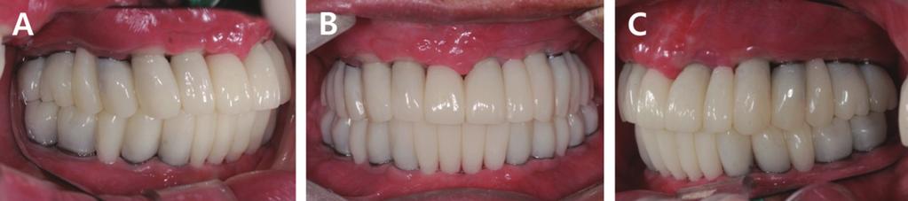 Full contour wax-up for provisional restorations.