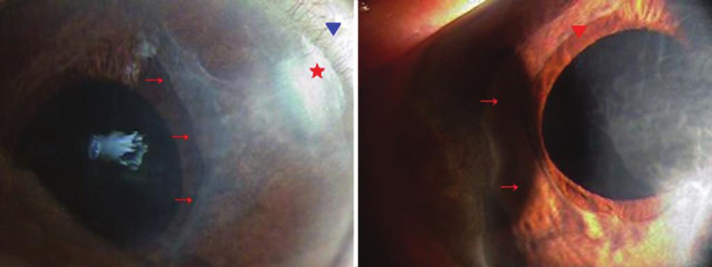 - 대한안과학회지 2009년 제 50 권 제 2 호 - Figure 1. nterior segment photograph shows diffuse sheet-like epithelial membrane covers from clear cornea incision site to around the pupil margin.