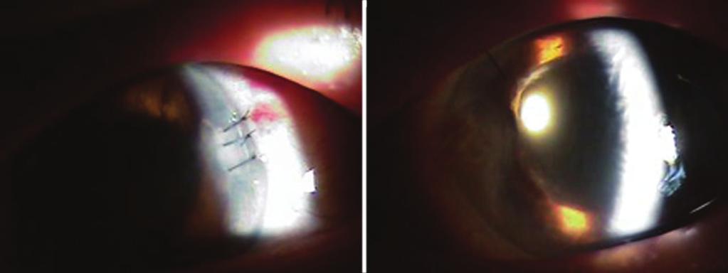 - 강희영외 : 백내장수술후발생한각막상피내생 - Figure 3. nterior segment photographs at one day after removal of the whole membrane in the anterior chamber. Clear corneal incisioned site was closed with nylon ().