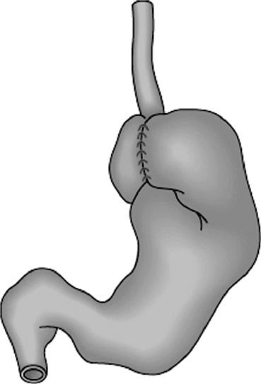 The Korean Journal of Gastrointestinal Endoscopy Room B 위장관수술후상부위장관내시경검사 김지원 서울대학교의과대학내과학교실 Endoscopy in Surgically Altered Anatomy Ji Won Kim, M.D.