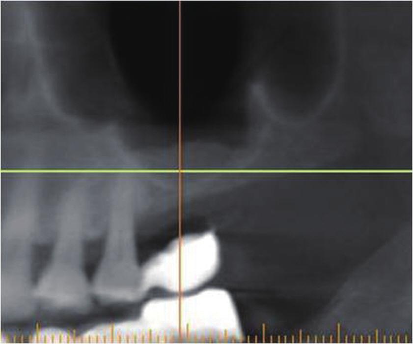 CS kit와이종골이식재 (io-oss, Geistlich) 를이용하여상악동골이식술을시행하고직경 4 mm, 길이 13 mm의 SL 표면을가지는내부연결형임플란트 (TS III S, Osstem) 를식립하였다 (Fig. 4C). 최종드릴은 2.