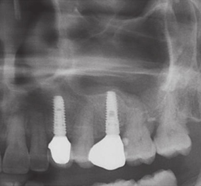 Implant placement simultaneously sinus augmentation using crestal approach in severely atrophic