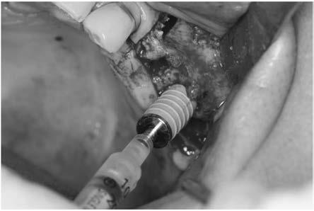 새롭게개발된 special drilling과 hydraulic pressure를이용한 sinus lifting instrument (Crestal approach sinus lift kt: CAS) 를예로들수있다 12-18). CAS kit (Osstem Implant Co.