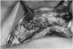 Ridge augmentation using family and autogenous tooth bone graft material was performed in 52-year old male