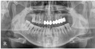 Kim SY, et al: Family tooth bone graft: case observational study 17 A B C D E F Fig. 2.