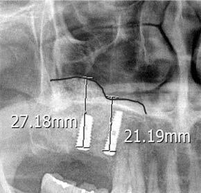 Kang DW, Kim YK: Repair of large maxillary sinus membrane perforation using a collagen membrane: retrospective clinical study 3 Fig. 2.