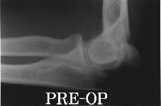 675 Sixty-four-year-old-male Preoperative simple lateral radiograph,