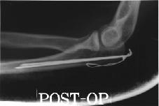 was between 2-3 weeks after operation postoperative 12 months radiograph,