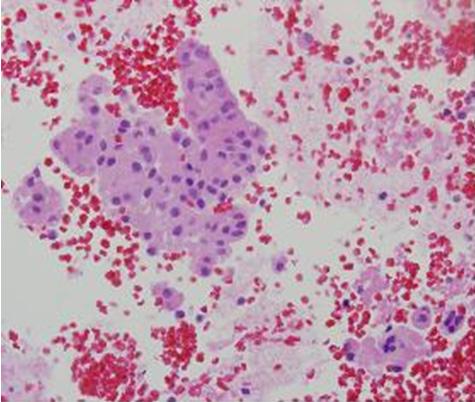 - Song Ju Lee, et al. Renal cell carcinoma wiht mediastinal lymphadenopathy diagnosed by EBUS-TBNA - Figure 3. A huge bulging mass is seen at the right upper pole of the kidney, abutting the liver.