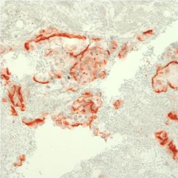 - 대한내과학회지 : 제 78 권제 1 호통권제 593 호 2010 - Figure 5. Immunohistochemical staining for CD10 shows that the epithelial tumor cells stained brown.