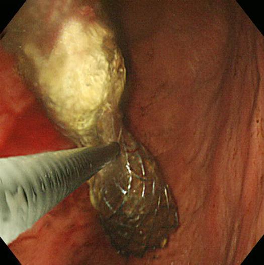 Figure 3. Endoscopic findings of stent removal using argon plasma coagulation (APC).