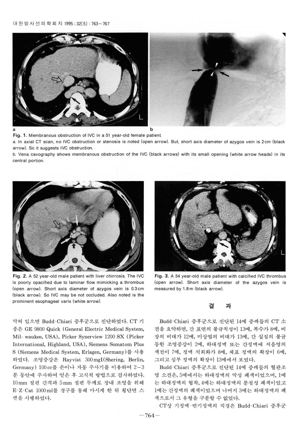 대한방사선의학회지 1995 : 32(5): 763-767 a b Fig. 1. Membranous obstruction 01 IVC in a 51 year-이 d lemale patient a. In axial CT scan, no IVC obstruction or stenosis is noted (open arrow).