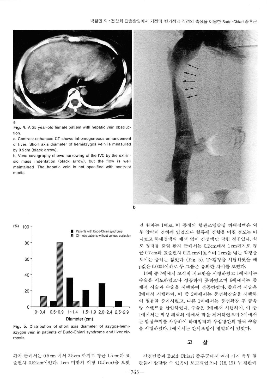 박칠민외 : 전산화단층촬영에서기정맥반기정맥직경의측정을이용한 Budd -Chiari 증후군 a Fig. 4. A 25 year-old female patient with hepatic vein obstruction a. Contrast-enhanced CT shows inhomogeneous enhancement of liver.