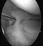 전재균외 : 동종반월상연골이식후이차관절경소견및 MRI 를이용한임상적결과 41 Fig. 7.