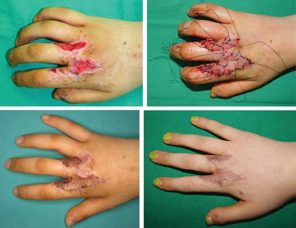 J Korean Soc Surg Hand Vol. 16, No. 2, June 2011 Fi g. 1. Photographs of the hand in 10-year-old female who underwent AlloDerm graft and split thickness skin graft for wound reconstruction.