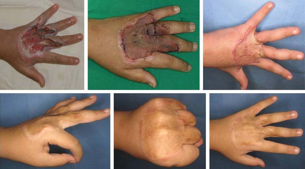 Hyung Min Hahn, et al. Treatment of Complex Open Wounds Using AlloDerm in Hand and Foot Fi g. 2.
