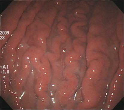pylori 미감염의위저선점막에는규칙적으로배열하는미세한붉은점들이관찰된다.