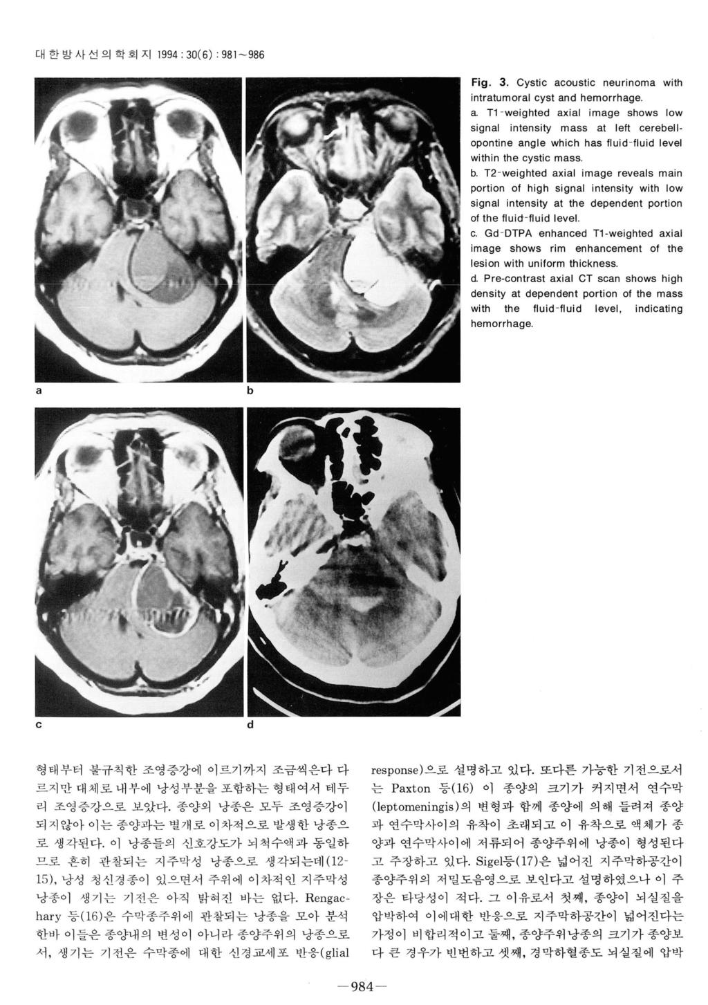 대한방사선의학회지 1994: 30(6) : 981-986 Fig. 3. Cystic acoustic neurinoma with intratumoral cyst and hemorrhage a.