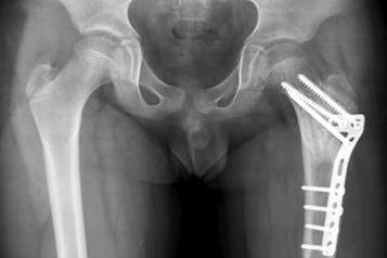 소아에서잠김금속판을이용한장관골골간단부병적골절의치료 541 Fig. 1.