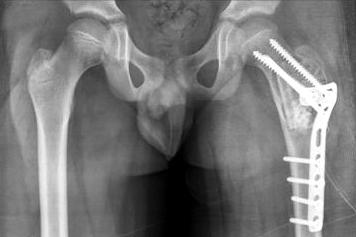 (B) Immediately postoperative radiograph shows curettage and autologous fibula and calcium sulfate (osteoset R ) graft for the aneurismal bone cyst