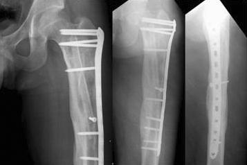 (B) Immediately postoperative plain radiographs shows curettage and autologous fibular and calcium sulfate (osteoset R ) graft for the simple bone