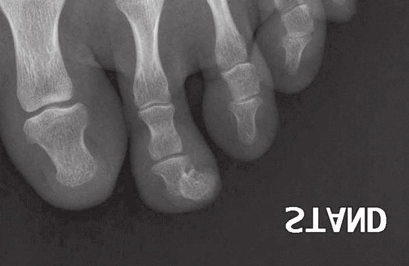 Serial radiographs of a 24-year-old man with a secondary chondrosarcoma originating from the proximal tibia