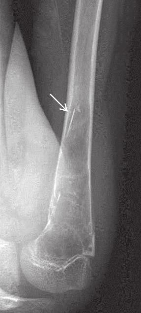 () monostotic fibrous dysplasia in the proximal femur showing a ground glass appearance.