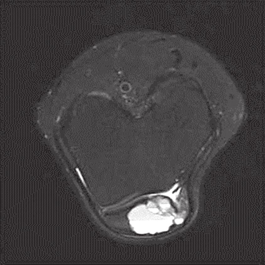 ipsilateral hip joint (arrow). () coronal magnetic resonance image of a chondroblastoma showing extensive edema around the lesion.