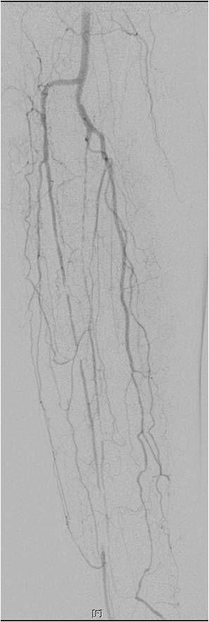Endovascular Management for Infrapopliteal Stenocclusive Lesions Manifestating Critical Limb Ischemia 19