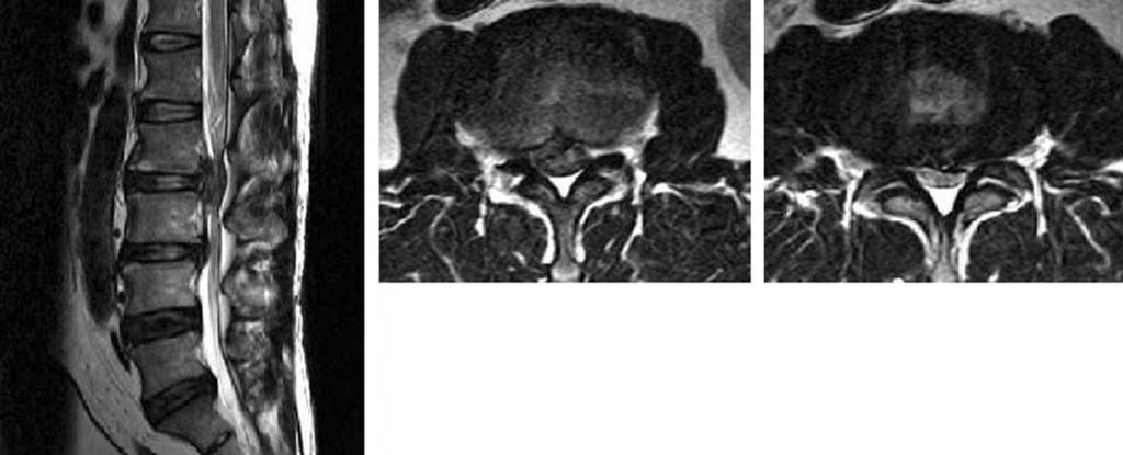 급성마미증후군환자의수술적치료후 May-Thurner 증후군으로생긴심부정맥혈전증 - 증례보고 - 유정현외 추부자기공명영상소견상요추 2-3 번간, 3-4 번간의심한추간판탈출증소견을보여급성마미증후군으로진단되었다 (Fig. 1). 증상발현 12 시간이내에후방감압술및기기고정술을이용한후외방유합술을시행하였다 (Fig. 2).