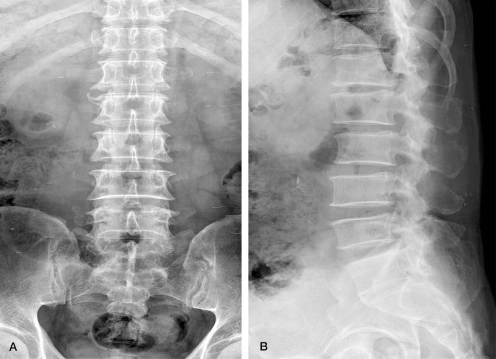 Journal of Korean Society of Spine Surgery Intradural Disc Herniation - A Case Report- Fig. 1. Preoperative AP (A) and lateral (B) x-rays.