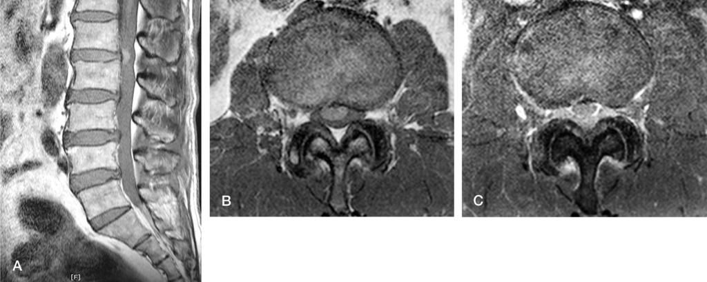 T1- and T2-weighted images in non-contrast sagittal and axial MRI (T1WI) (A, B). Gadoliniumenhanced T1-weighted MRI shows ring enhancement of the mass(c).