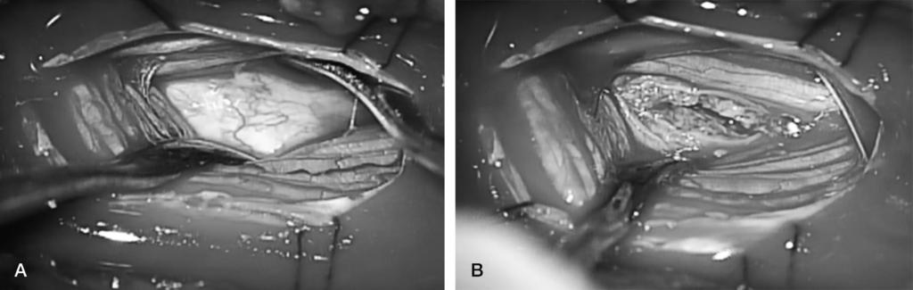 Jaewon Lee et al Volume 21 Number 3 September 2014 Fig. 3. Intra-operative clinical photo shows intradural egg-shaped mass after dural incision(a, B). Fig. 4.