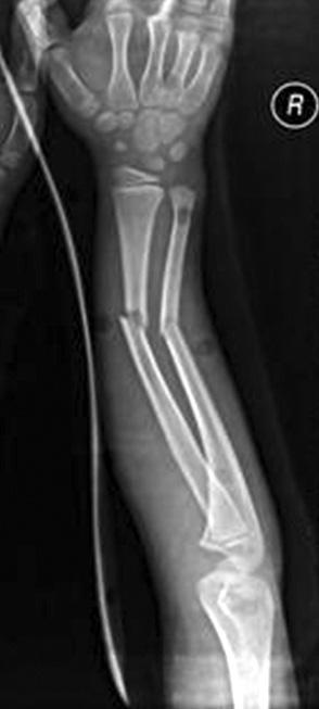(A) Preoperative radiograph of a 8-year-old boy shows both bones were equally displaced.