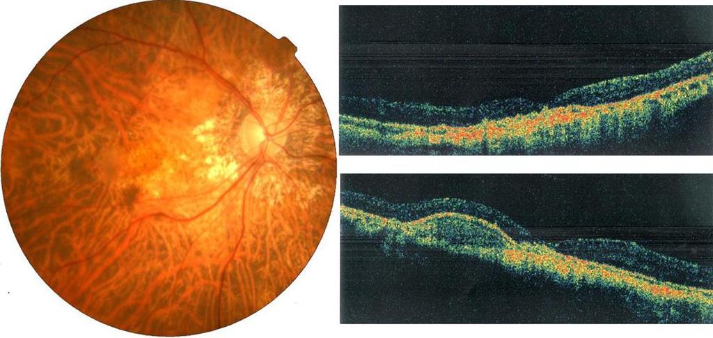 () Fundus photograph four months after the vitrectomy, the internal limiting membrane peeling and the fluid-gas exchange.