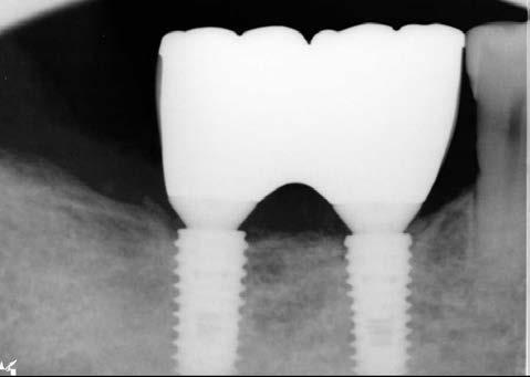 The healing of extraction socket was incomplete. Implant (Dentium Superline. 5D/8L) was installed.
