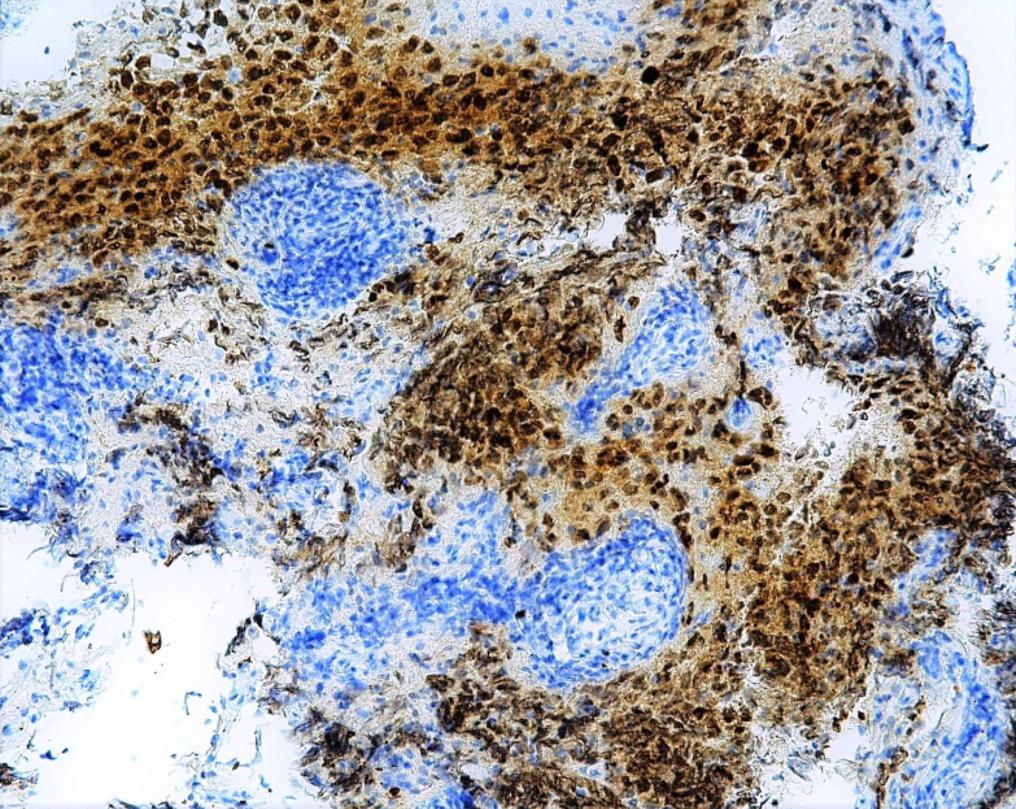 (B) Strong nuclear staining for OCT3/4 ( 200). (C) Positive immunohistochemical staining for placental alkaline phosphatase ( 200).