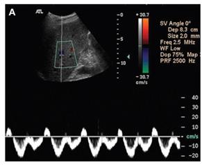 정승원 도플러초음파를이용한간문맥과간정맥혈류의측정 Figure 5. Hepatic vein waveform on doppler ultrasonography. A.