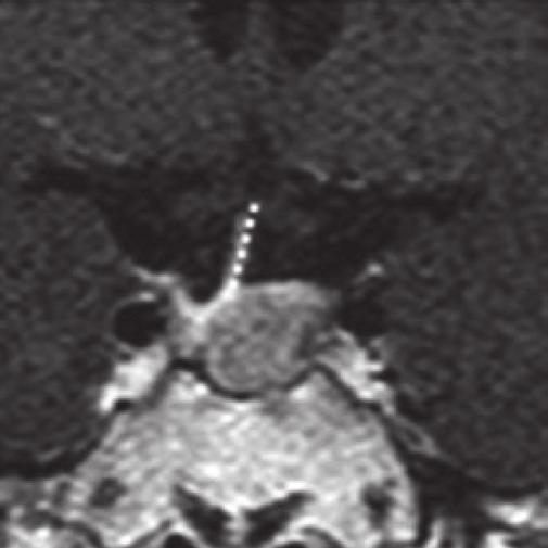 6%) MRI findings Tumor diameter (mm) 27.87 ± 9.93 (5.35-60.31) Thickness of pituitary gland (mm) 1.42 ± 2.07 (0-11.68) Presence of stalk compression (%) Normal stalk morphology 40 (10.