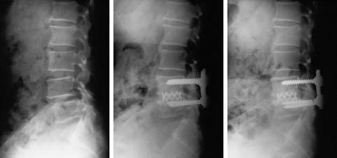 fusion A B C Fig 1-A Lateral radiograph at 70-year-old male with degenerative spondylolisthesis Fig 1-B Lateral radiograph at seven-month follow-up examination shows distal