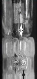 - 대한내과학회지 : 제 89 권제 3 호통권제 661 호 2015 - A B C Figure 5. The DESolve stent (Elixir Medical Corporation, Sunnyvale, CA, USA).