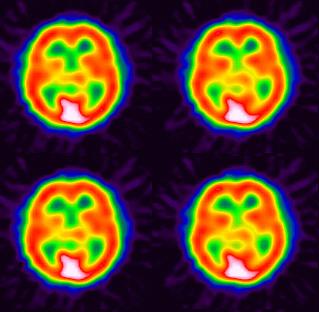 - 김현성외 6 인. 당뇨병성케톤산증과동반된편무도증 1 예 - Figure 3. Diamox stress brain SPECT reveals increased blood flow in the left basal ganglia. 게밝혀져있지않으나기저핵의 GABA 결핍이주된기전이라는가설이있다 5).