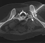 (B) The laser sights of the CT gantry indicated the cutaneous location of CT image slice.
