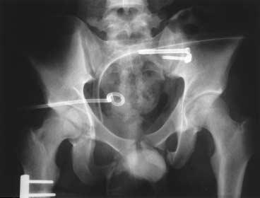 후방골반환손상환자에서의국소마취하 CT 를이용한경피적천장관절나사고정술 725 2 1 A 3 B C D Fig. 2. (A) Anteroposterior pelvic radiograph of 20-year-old patient with left sacroiliac joint separation made at the time of the injury.